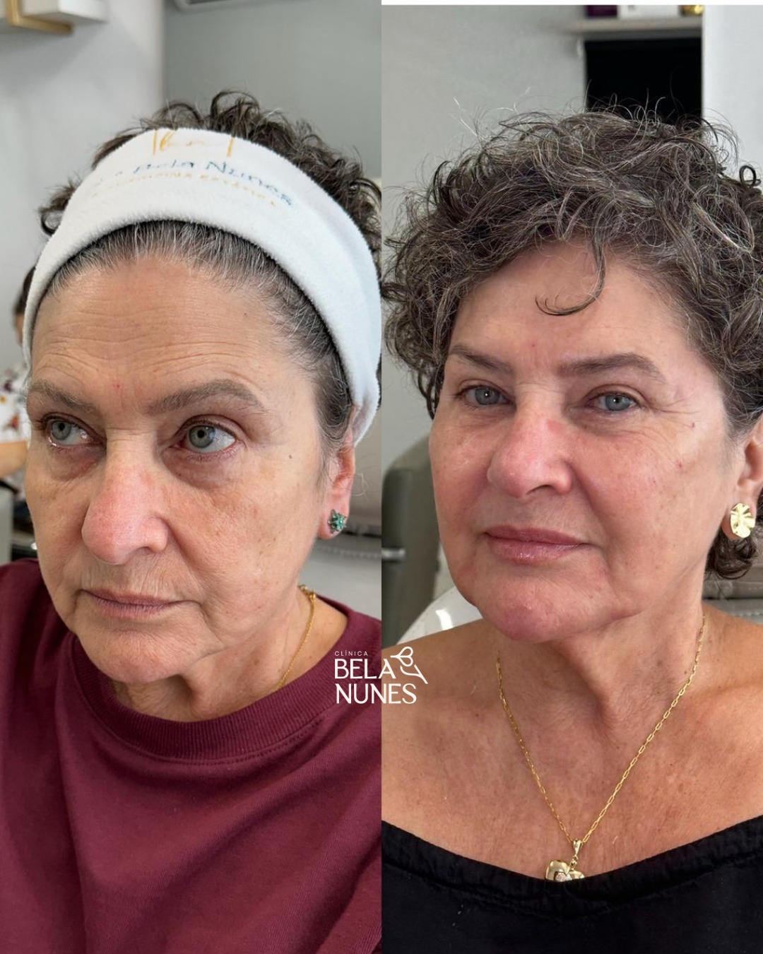 Resultado 6: antes e depois