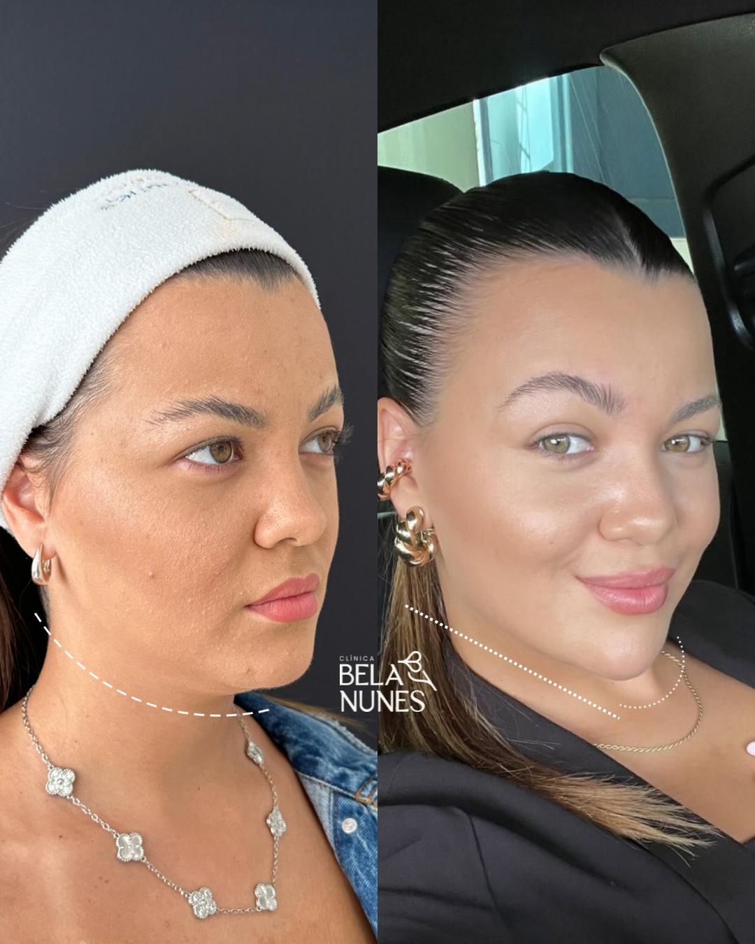 Resultado 16: antes e depois