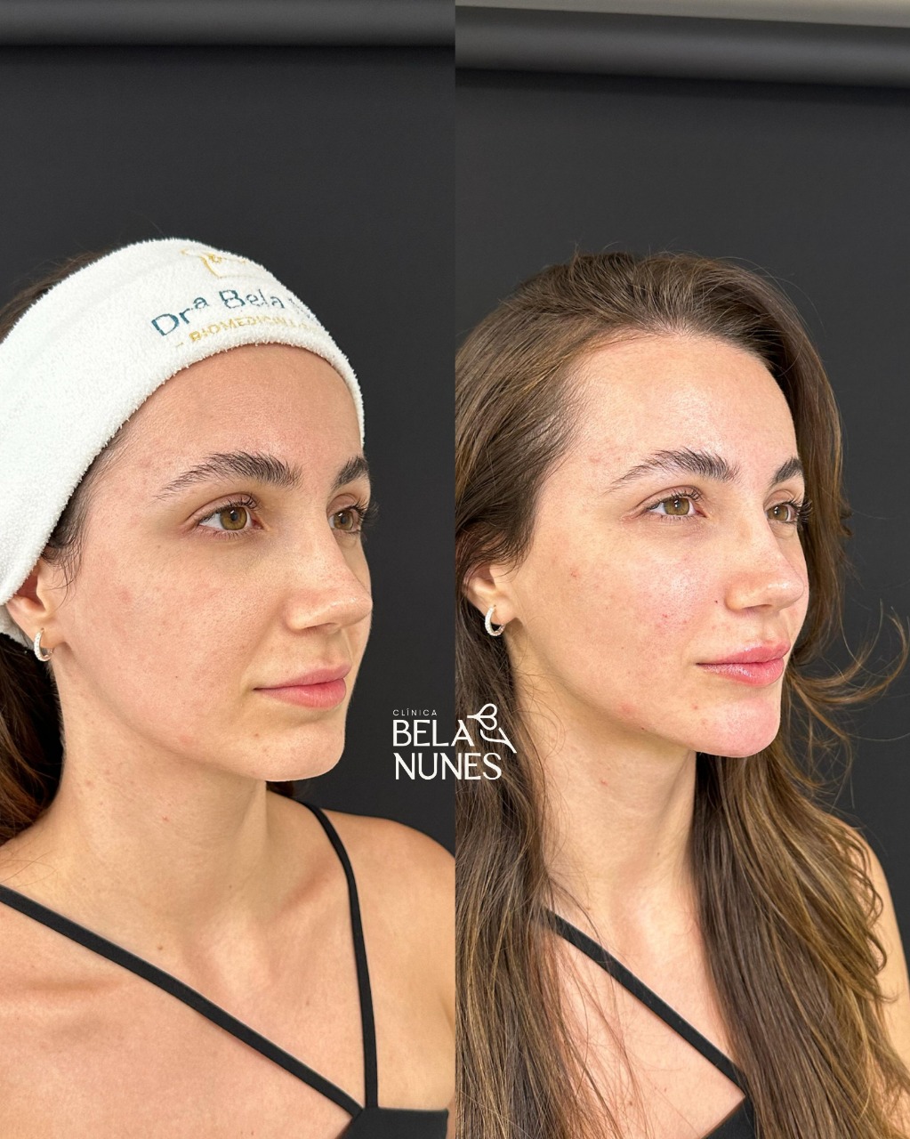 Resultado 17: antes e depois